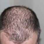 Does Creatine Cause Hair Loss.