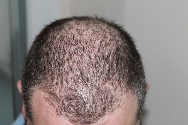 Does Creatine Cause Hair Loss.