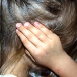 PCOS Hair Loss