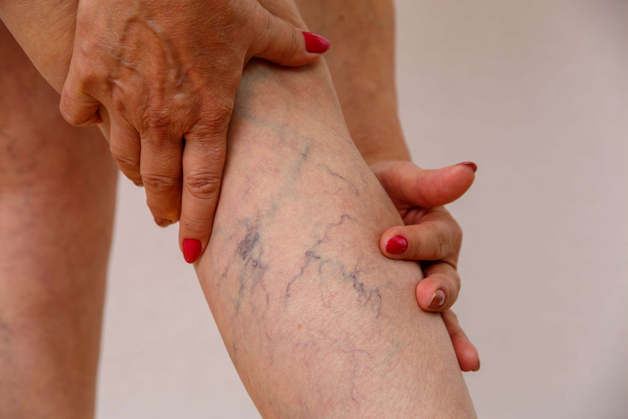 What you should know about Varicose Vein Condition