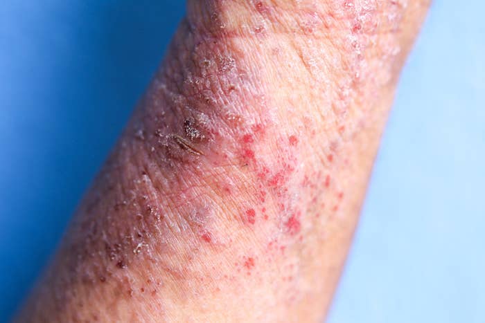 Remember These Things While Going For Eczema Treatment