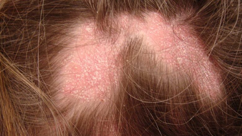 Scabs And Sores On The Scalp: What Causes Them And How To Treat Them ...