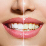 How the dentist will help you to smile with clear and shiny teeth!!