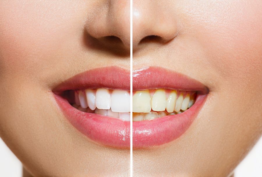 How the dentist will help you to smile with clear and shiny teeth!!