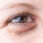 Dark Eye Circles Removal