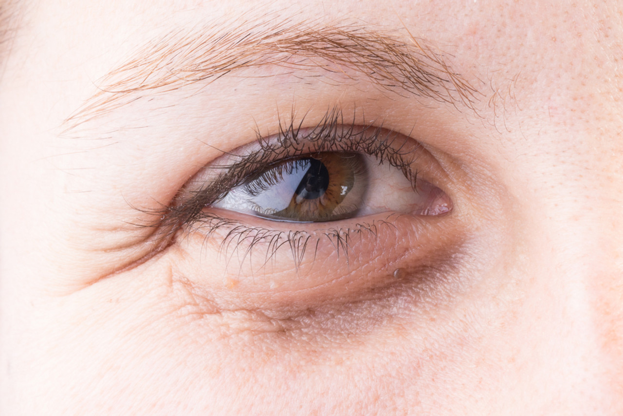 Dark Eye Circles Removal