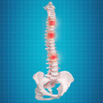 Spinal Disc Replacement