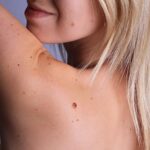 skin cancer removal St Petersburg